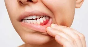 Periodoncia